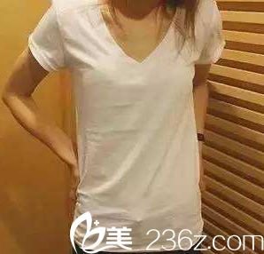 在宁波美莱做假体隆胸前 在宁波美莱做假体隆胸前