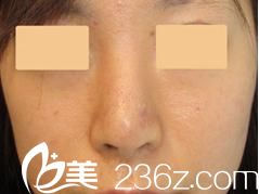 银座紫罗兰花美容形成外科医院鼻部修复前 银座紫罗兰花美容形成外科医院鼻部修复前