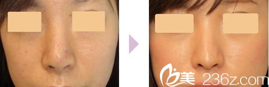 20190102_1546398623841143.jpg 手术前后对比.jpg