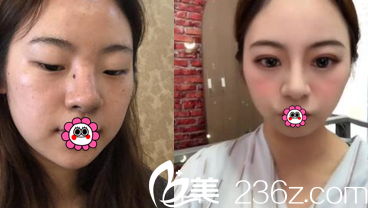 北京艺星眼综合案例