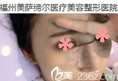 做完膨体加耳软骨隆鼻第5天