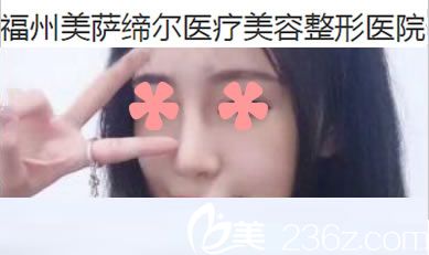 在福州美萨缔尔做完膨体加耳软骨鼻综合一个月效果