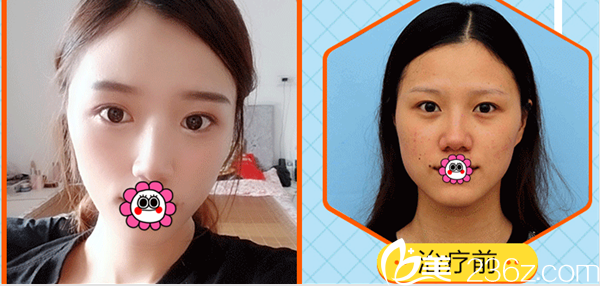 北京艺星王丹丹医生美肤祛痘案例 北京艺星王丹丹医生美肤祛痘案例