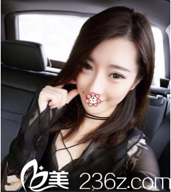 1年前在国内做的埋线双眼皮两只眼睛不对称了，所以我去了韩国GIO整形车知勳那儿做双眼皮失败修复！