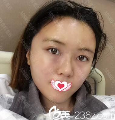 自体脂肪填充全脸术后天 自体脂肪填充全脸术后天