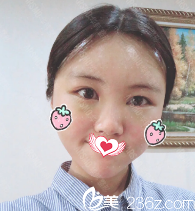 面部脂肪填充术后第7天 面部脂肪填充术后第7天