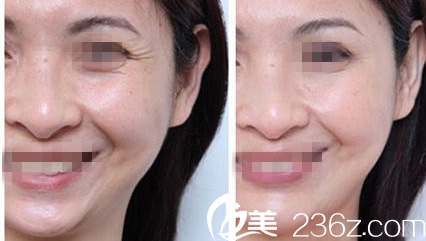 Dr. Lee注射瘦脸除皱案例