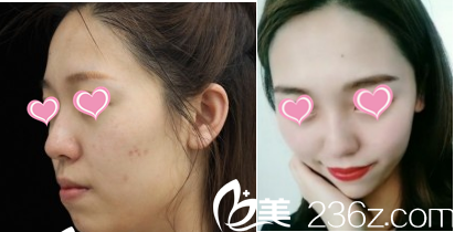 Dr. Lee 注射案例