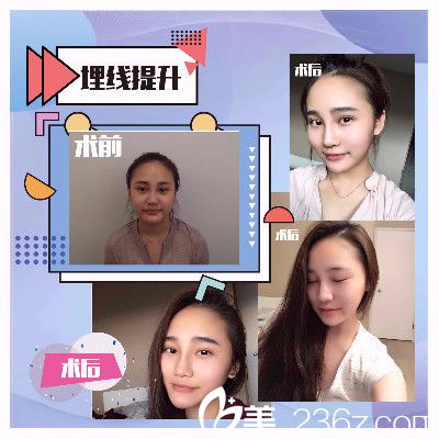 香港FMH医学美容线雕提升真人案例 香港FMH医学美容线雕提升真人案例