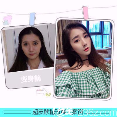 香港FMH医学美容超皮秒祛斑案例 香港FMH医学美容超皮秒祛斑案例