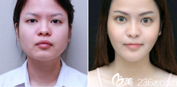 泰国曼谷F CLINIC医美诊所V-LINE瓜子脸案例 泰国曼谷F CLINIC医美诊所V-LINE瓜子脸案例