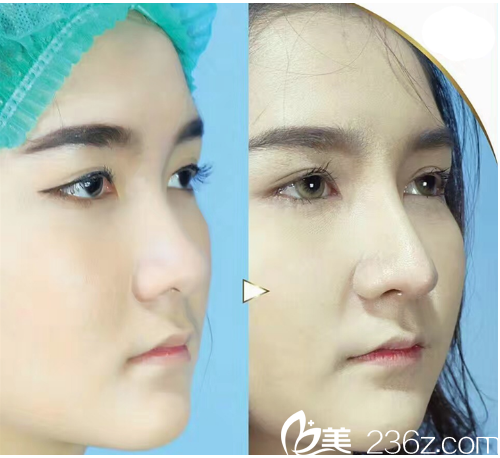 泰国曼谷F CLINIC医美诊所萨拉同隆鼻案例 泰国曼谷F CLINIC医美诊所萨拉同隆鼻案例