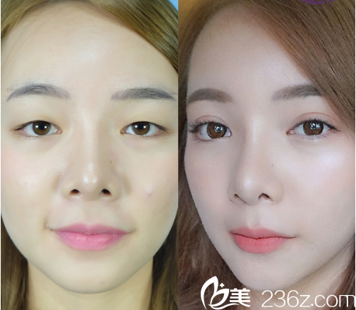 泰国曼谷F CLINIC医美诊所双眼皮案例 泰国曼谷F CLINIC医美诊所双眼皮案例