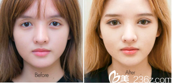 泰国曼谷F CLINIC医美诊所萨拉同双眼皮失败修复案例 泰国曼谷F CLINIC医美诊所萨拉同双眼皮失败修复案例