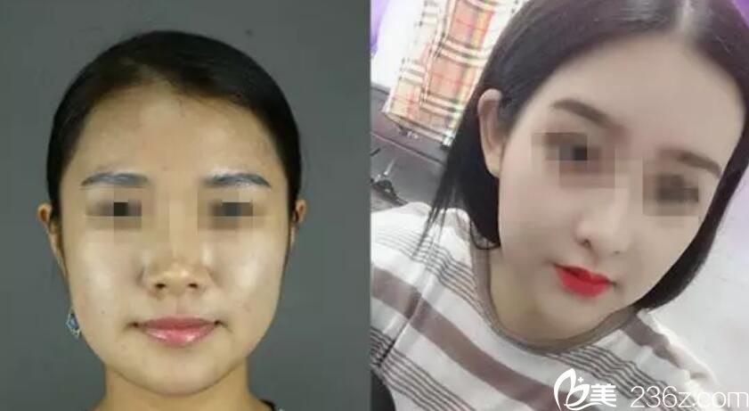 属于香港雅太医美修改脸型案例