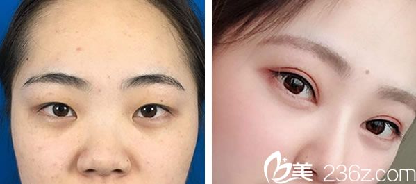 彭素全切双眼皮+耳软骨隆鼻效果对比图 彭素全切双眼皮+耳软骨隆鼻效果对比图