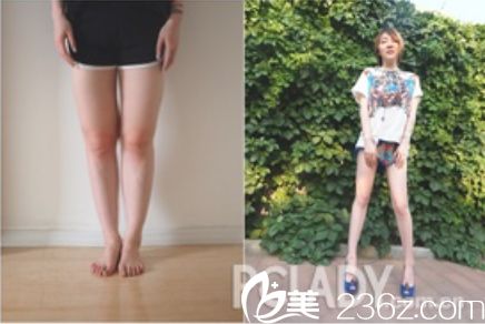 中国台湾尼斯大腿吸脂案例