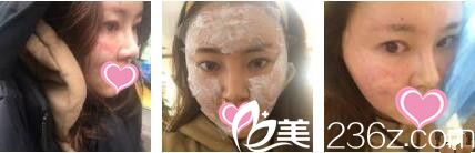 香港美生堂医学美容中心林医生面部埋线提升真人案例术后天