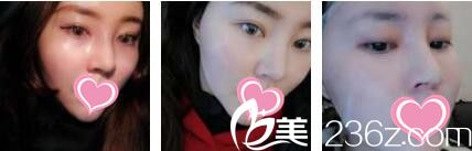 香港美生堂医学美容中心林医生面部埋线提升真人案例术后第七天