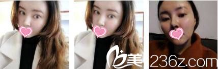 香港美生堂医学美容中心林医生面部埋线提升真人案例术后十五天