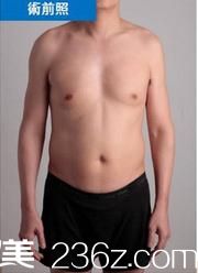 咖蒙整形医院威塑4D手术前 咖蒙整形医院威塑4D手术前