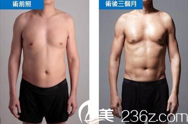 威塑4D脂肪雕刻技术手术前后对比照片 威塑4D脂肪雕刻技术手术前后对比照片