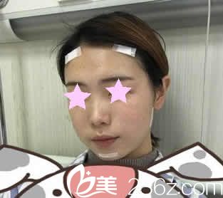 我在南宁东方整形做自体脂肪填充术后第3天照片