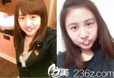 中国台湾星和医疗双眼皮案例 中国台湾星和医疗双眼皮案例