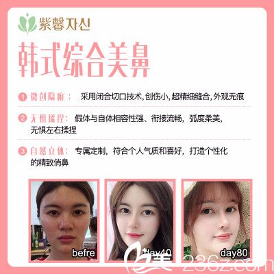 广州紫馨姬付康做的隆鼻子案例