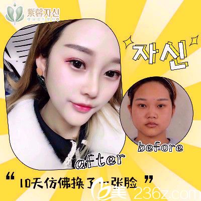 广州紫馨李政祐做的隆鼻子案例