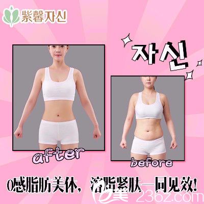 广州紫馨全身吸脂案例