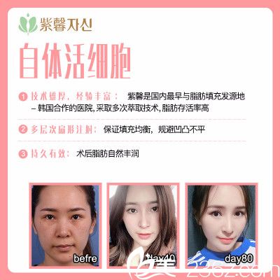 广州紫馨自体脂肪填充案例