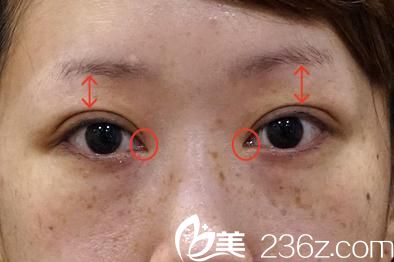 日本修复双眼皮哪个医院好? 反馈一下我在日本Sapho美容整形医院做的天然双眼皮