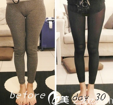 中国台湾童顏医疗美容腿部吸脂案例 中国台湾童顏医疗美容腿部吸脂案例