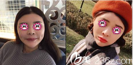 中国台湾童顏医疗美容瘦脸除皱瘦脸案例 中国台湾童顏医疗美容瘦脸除皱瘦脸案例