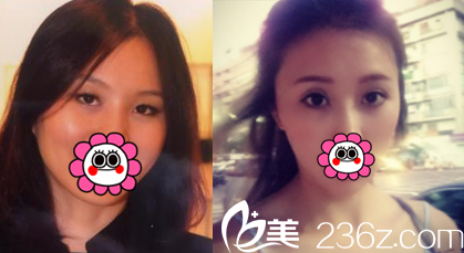 中国台湾童顏医疗美容双眼皮开眼角案例 中国台湾童顏医疗美容双眼皮开眼角案例