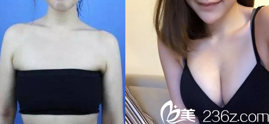中国台湾童顏医疗美容自体脂肪丰胸案例 中国台湾童顏医疗美容自体脂肪丰胸案例