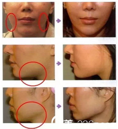 庄凯复线雕提升案例对比