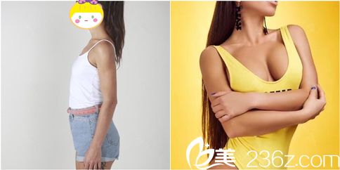 重庆华美假体隆胸案例效果 重庆华美假体隆胸案例效果