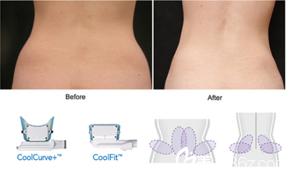 罗也纳皮塔亚功医生讲冷冻溶脂以及案例分享 罗也纳皮塔亚功医生讲冷冻溶脂以及案例分享