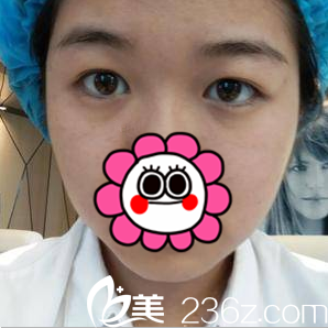 在中国台湾童颜医疗美容医院做切开双眼皮前样子 在中国台湾童颜医疗美容医院做切开双眼皮前样子