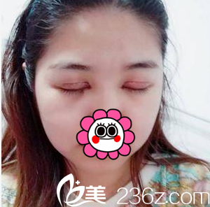 张智辉给我做切开双眼皮第8天效果 张智辉给我做切开双眼皮第8天效果