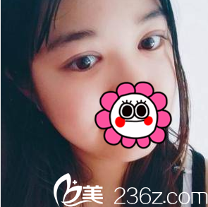 在中国台湾童颜医疗美容医院做切开双眼皮第21天效果 在中国台湾童颜医疗美容医院做切开双眼皮第21天效果