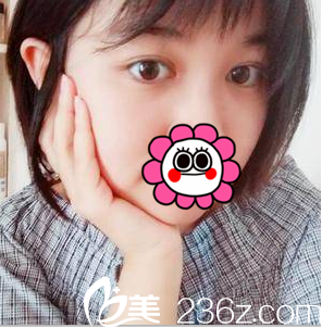 中国台湾童颜医疗美容医院切开双眼皮案例 中国台湾童颜医疗美容医院切开双眼皮案例