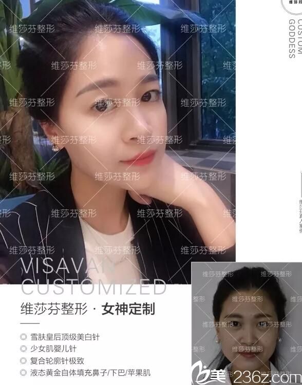 香港维莎芬整形怎么样？来看真人蜕变案例