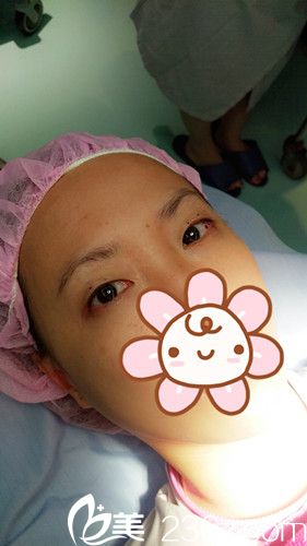 在中国台湾风华做双眼皮前是无神单眼皮 在中国台湾风华做双眼皮前是无神单眼皮