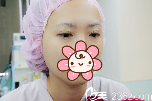 高义盛刚做完双眼皮术后有流畅线条 高义盛刚做完双眼皮术后有流畅线条