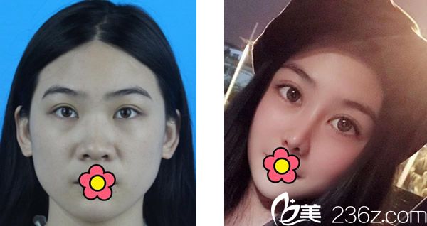 香港集美整形王洪医生自体肋软骨综合隆鼻案例 香港集美整形王洪医生自体肋软骨综合隆鼻案例