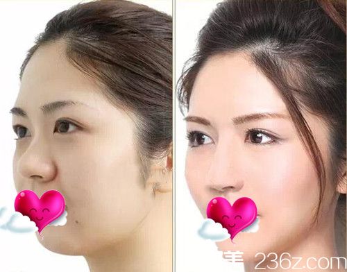 CLINICX无创微整形面部轮廓整形案例效果图