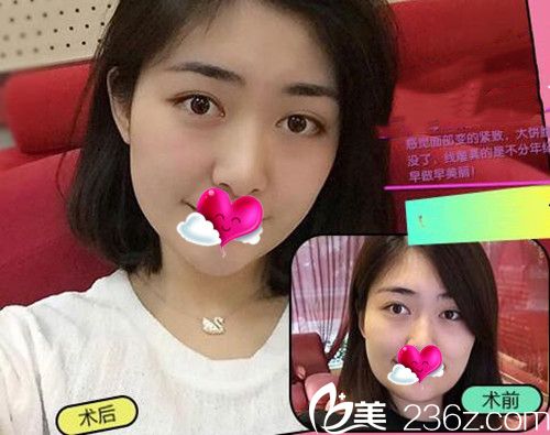 Dr.Kim金钟明做的埋线提拉效果对比图